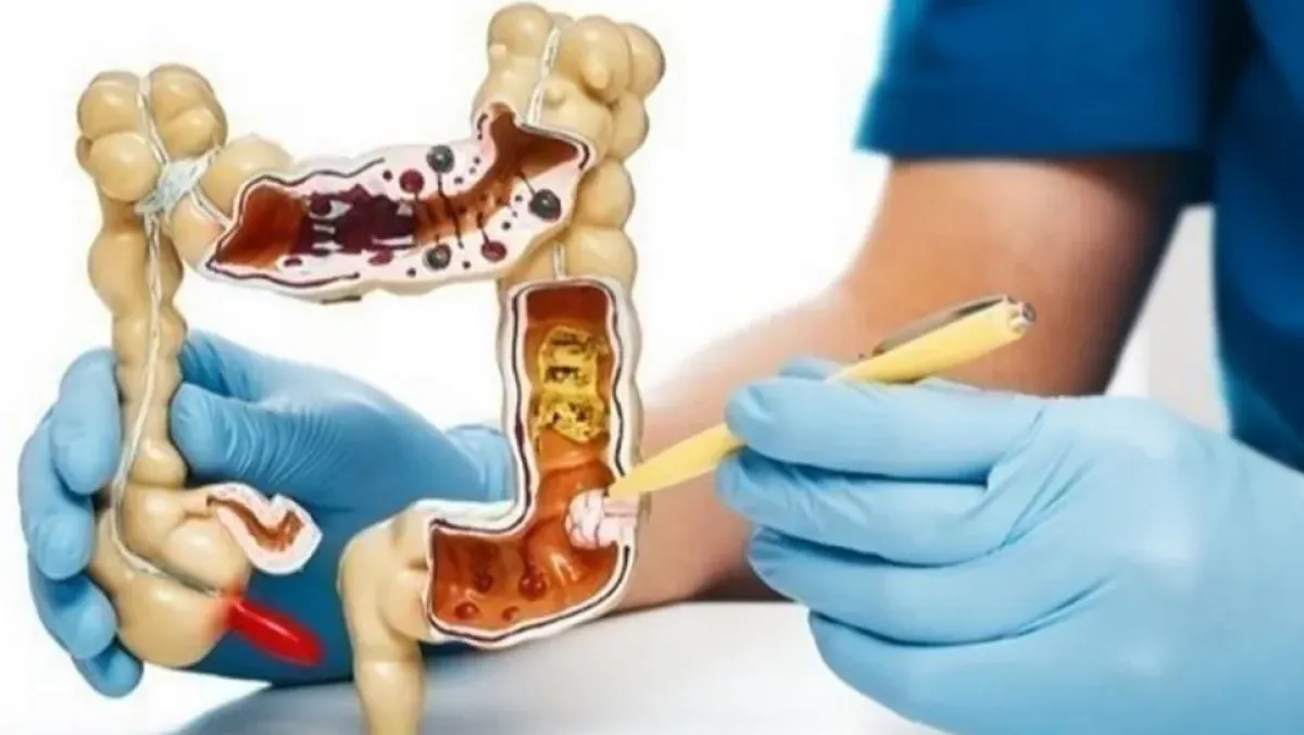 استهلاك المشروبات السكرية يضاعف خطر سرطان الأمعاء