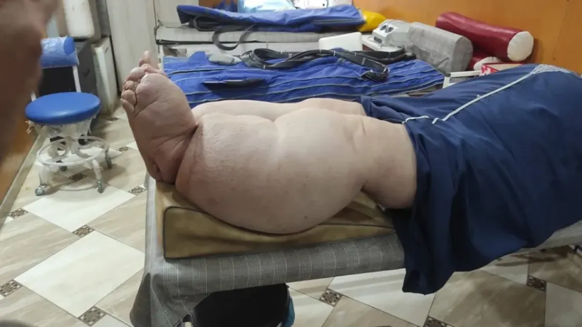 مركز الشفاء بالمدية يستقبل ضمادات ألمانية لعلاج الوذمة اللمفاوية