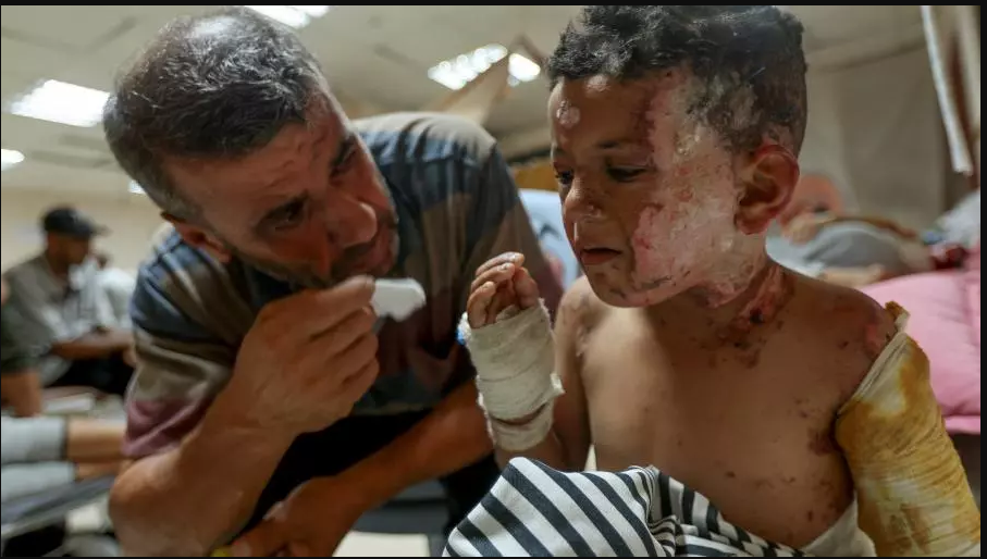 أطباء بلا حدود تحذر توقف أقنعة حروق الوجه في غزة